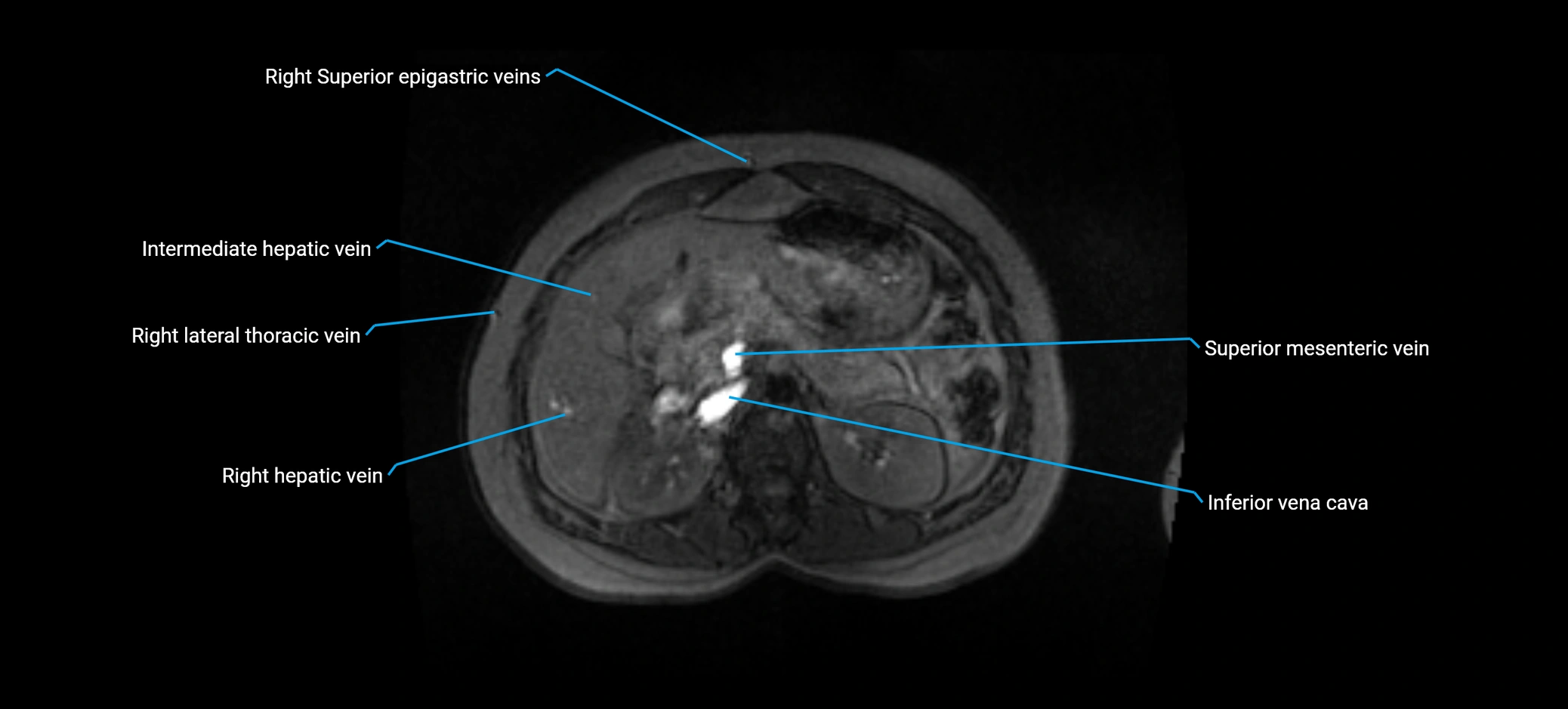 MRV abdomen pelvis & lower limb axial cross sectional anatomy labelled MRI image 56 (1).webp